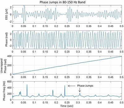 Increased Phase Cone Turnover in 80–250 Hz Bands Occurs in the Epileptogenic Zone During Interictal Periods